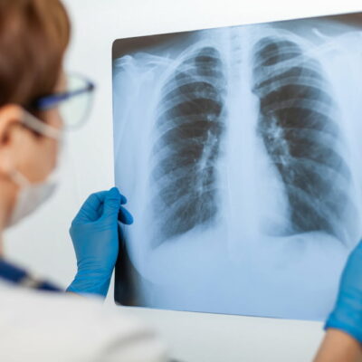 5 early warning signs of bone cancer